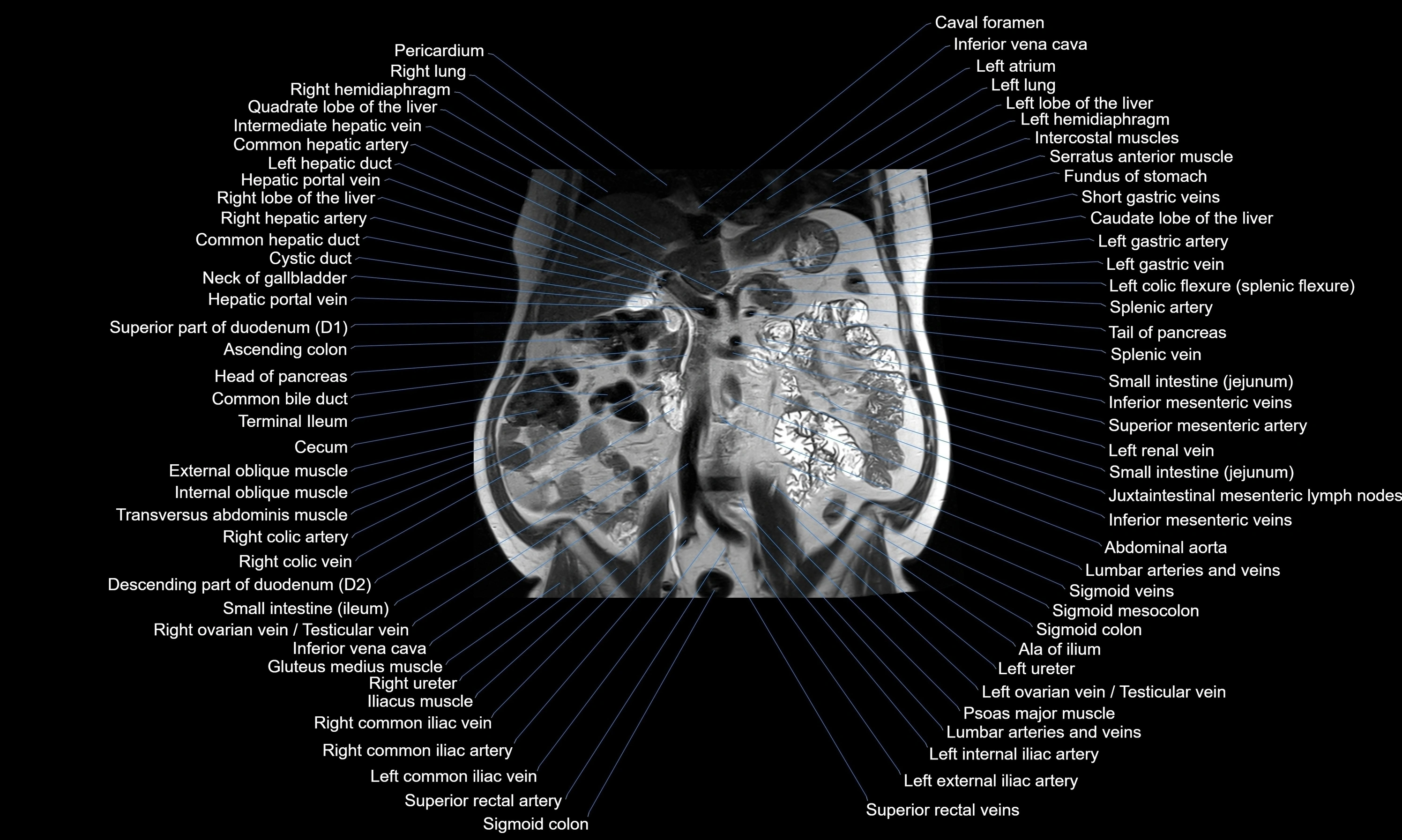 MRI Abdomen axial cross sectional anatomy radiology  image-img-00001-00029.webp